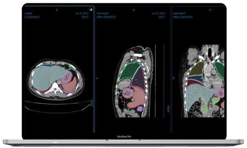 Aiken 3D Workstation showing AI organ segmentation across three CT views