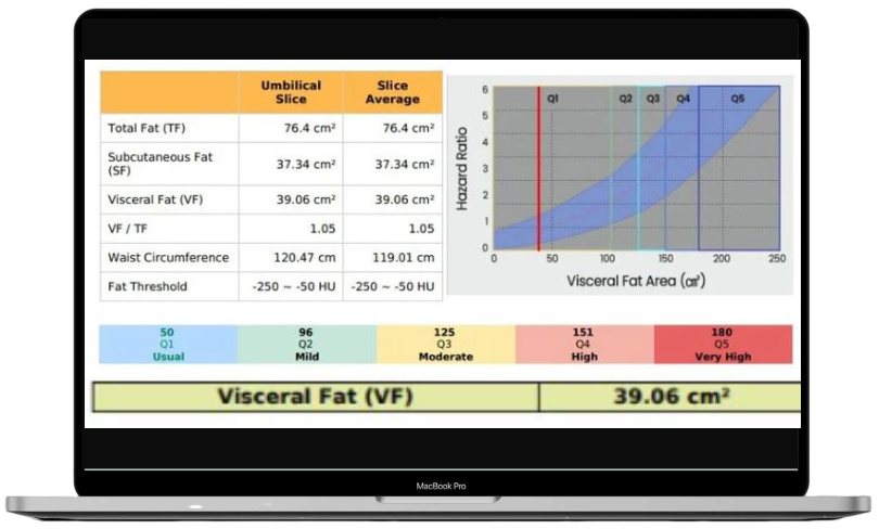 Aiken Adipo fat distribution report with visceral fat area and hazard ratio