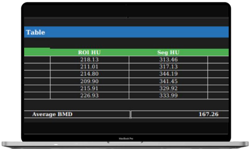 Aiken BMD results table showing ROI and segmented HU values with average BMD