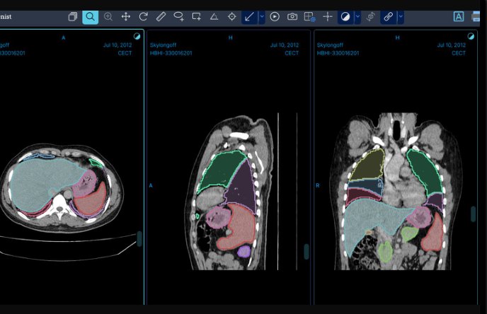 Aiken Viewer showing AI segmentation across axial, sagittal and coronal CT views