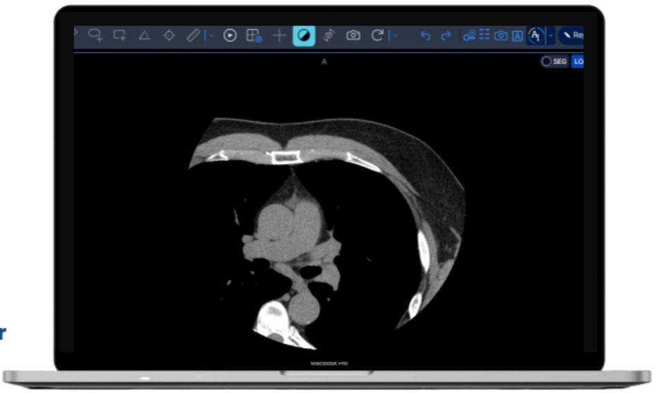 Calcium Scoring AI viewer showing a non-contrast cardiac CT slice