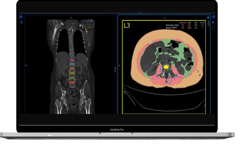 OncoSuite visceral fat measurement for cancer patients