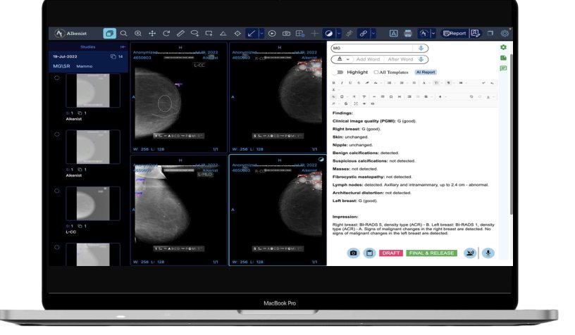 OncoSuite breast imaging analysis with structured report