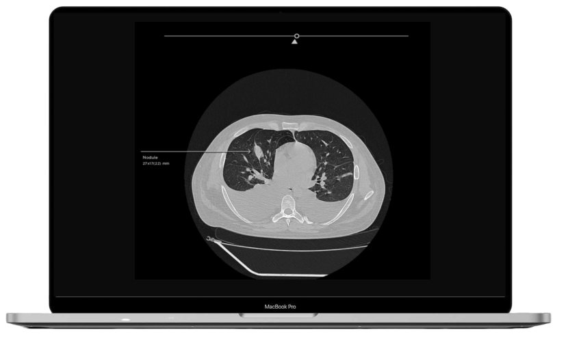 OncoSuite CT lung nodule detection shown on a laptop