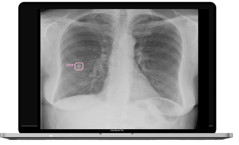 OncoSuite chest X-ray with an AI-flagged lung nodule