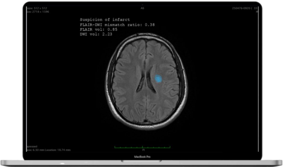 StrokeSuite MR stroke analysis showing FLAIR-DWI mismatch