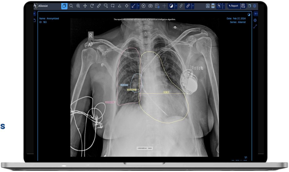XraySuite chest X-ray AI analysis with outlined findings