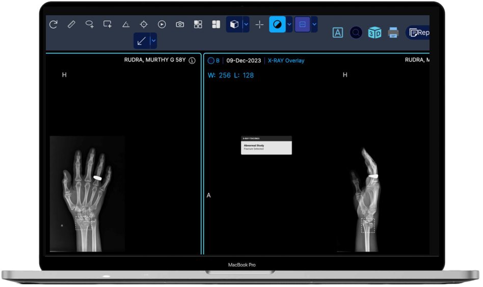 XraySuite hand fracture detection with side-by-side overlay